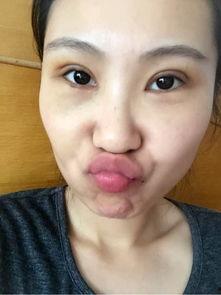 手术后吃瓜,瓜果飘香，助力康复之旅  第3张